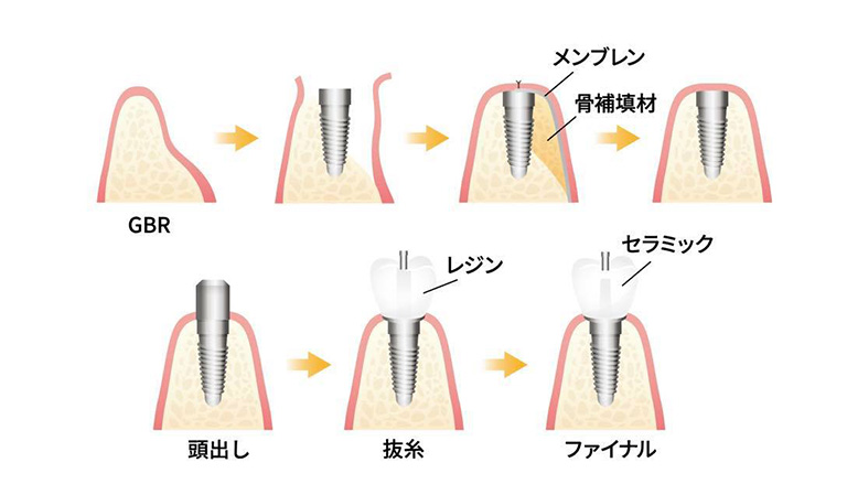 歯科手術メンブレンの手術方法イラスト