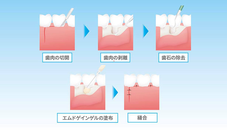 歯科手術イラスト